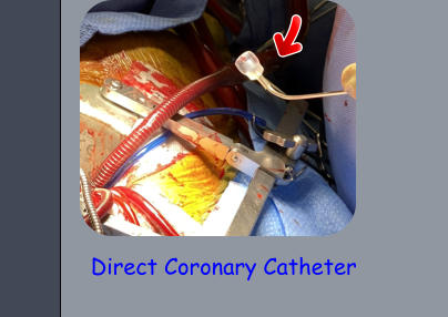 Direct Coronary Catheter