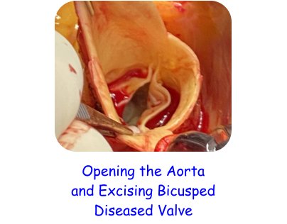 Opening the Aorta  and Excising Bicusped  Diseased Valve