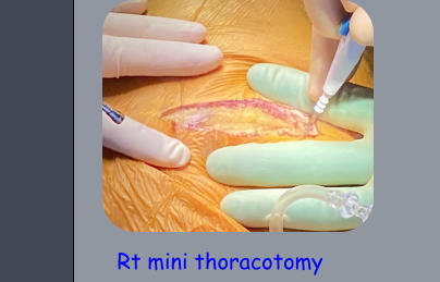 Rt mini thoracotomy