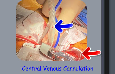 Central Venous Cannulation