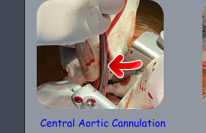 Central Aortic Cannulation