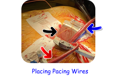 Placing Pacing Wires