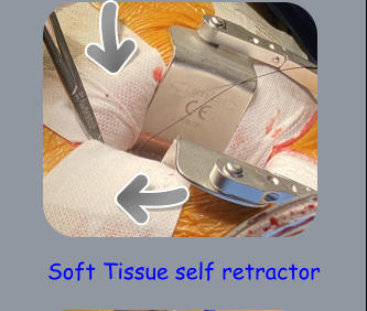 Soft Tissue self retractor