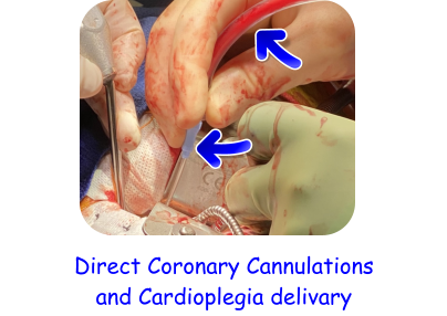 Direct Coronary Cannulations and Cardioplegia delivary