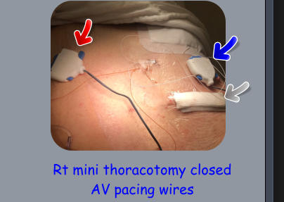 Rt mini thoracotomy closed AV pacing wires