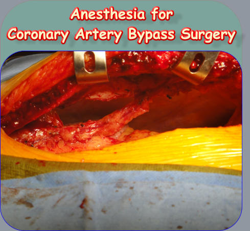 Anesthesia for  Coronary Artery Bypass Surgery